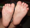 Hand-Foot-and-Mouth-Disease-6.jpg